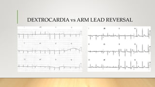 DEXTROCARDIA vs ARM LEAD REVERSAL
 
