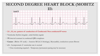 Mobitz Patterns ECG BASICS.pptx