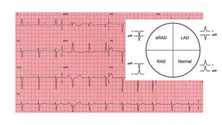 Rad Ecg Example ecg basics for physiotherapy students reference purpose | PPTX