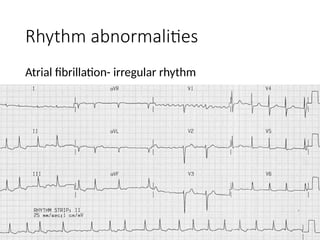 Comprehensive ECG Basics and Acute Coronary Syndrome Interpretation | PPTX