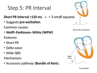 Comprehensive ECG Basics and Acute Coronary Syndrome Interpretation | PPTX