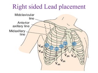 Right sided Lead placement
 