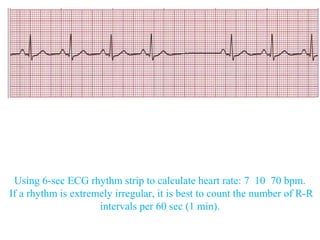 Ecg basics 1 | PPT
