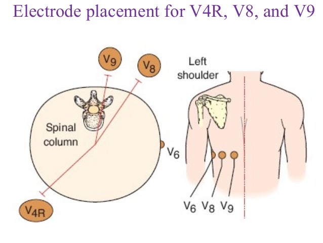 pediatric lead placement diagram pediatric lead placement diagram pediatric leads pediatric lead placement diagram pediatric lead placement diagram pediatric leads