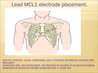 Lead MCL1 electrode placement.
 