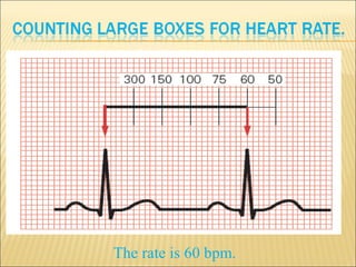 The rate is 60 bpm.
 