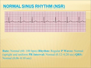 Rate: Normal (60–100 bpm) Rhythm: Regular P Waves: Normal
(upright and uniform PR Interval: Normal (0.12–0.20 sec) QRS:
Normal (0.06–0.10 sec)
 