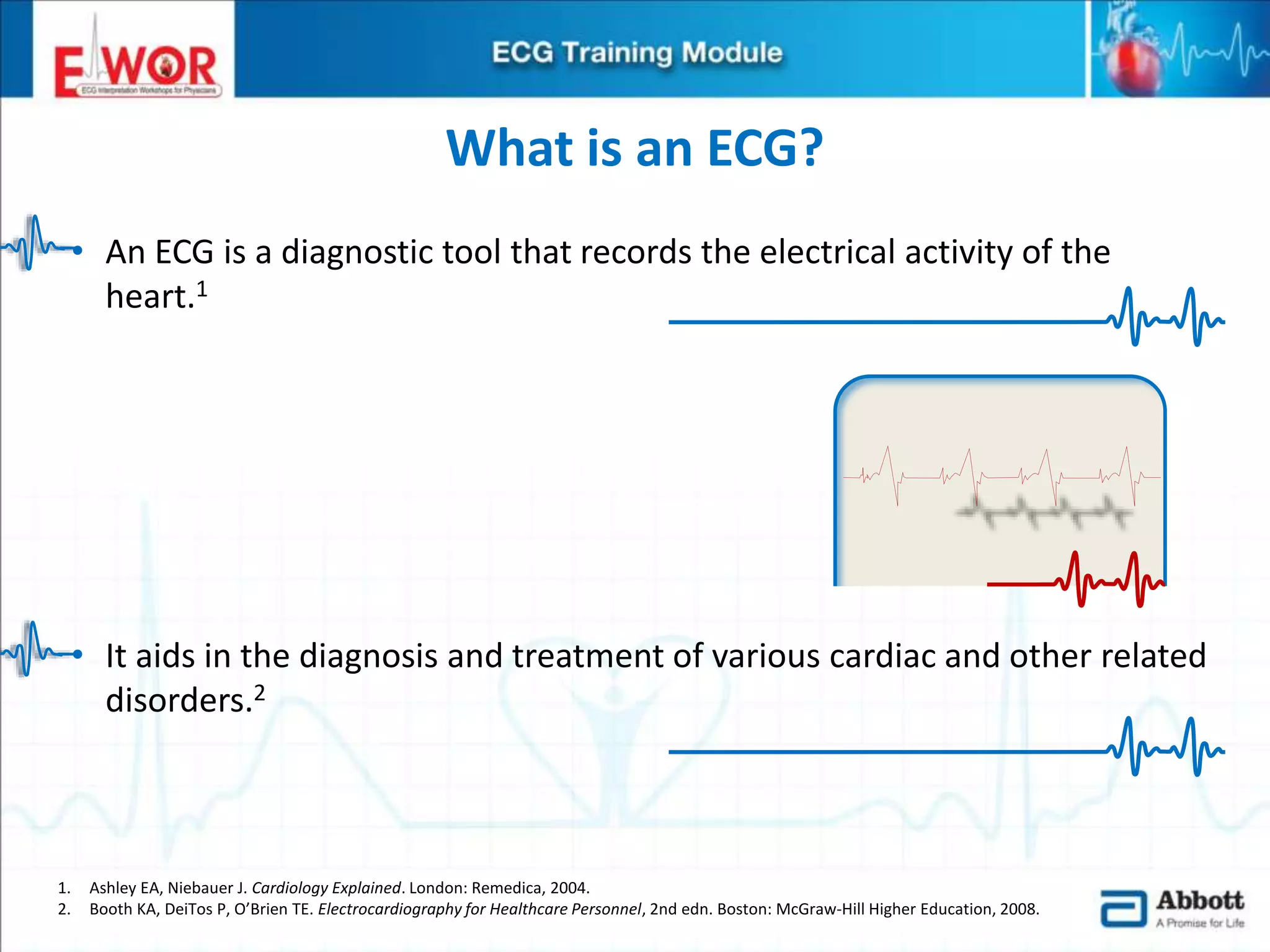 Ecg basics and interpretation | PPTX