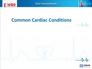 Ecg basics and interpretation | PPTX