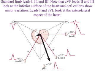 Standard limb leads I, II, and III. Note that aVF leads II and III
look at the inferior surface of the heart and defl ections show
minor variation. Leads I and aVL look at the anterolateral
aspect of the heart.
 