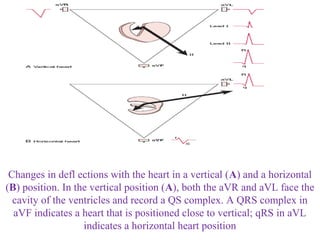 Changes in defl ections with the heart in a vertical (A) and a horizontal
(B) position. In the vertical position (A), both the aVR and aVL face the
cavity of the ventricles and record a QS complex. A QRS complex in
aVF indicates a heart that is positioned close to vertical; qRS in aVL
indicates a horizontal heart position
 