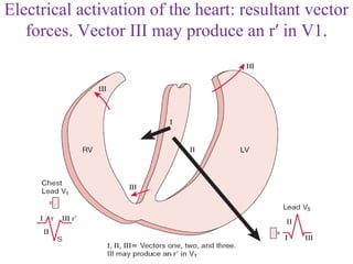Electrical activation of the heart: resultant vector
forces. Vector III may produce an r′ in V1.
 