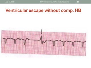 Ecg basics lecture 6 | PDF