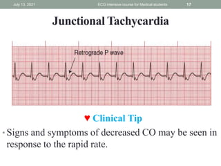 Junctional Tachycardia
July 13, 2021 ECG intensive course for Medical students 17
♥ Clinical Tip
• Signs and symptoms of decreased CO may be seen in
response to the rapid rate.
 