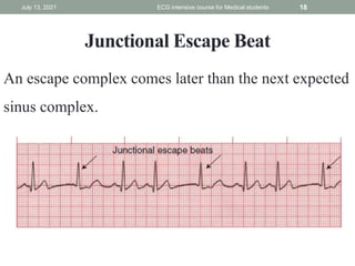 Junctional Escape Beat
An escape complex comes later than the next expected
sinus complex.
July 13, 2021 ECG intensive course for Medical students 18
 