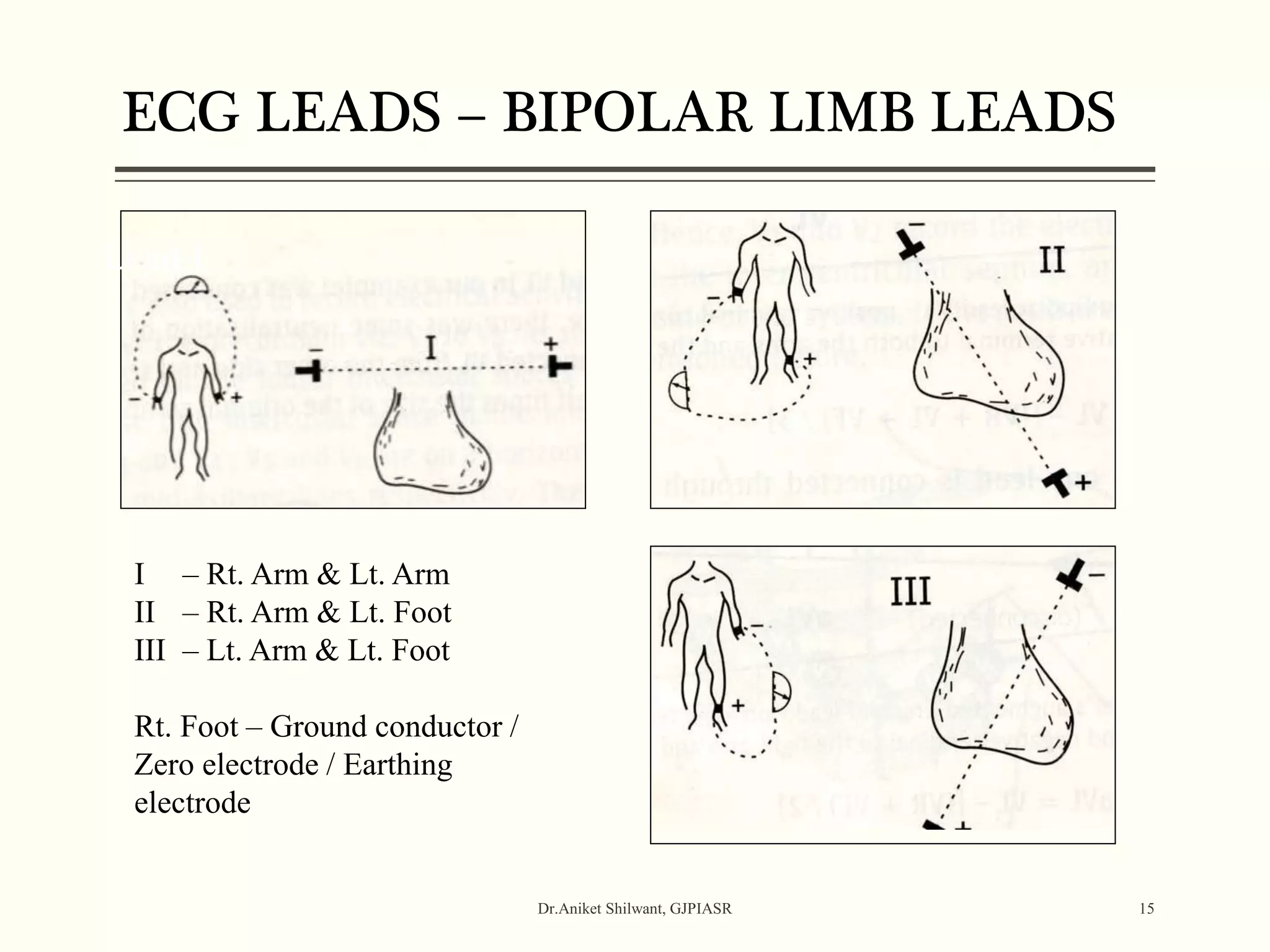 Lead I
Dr.Aniket Shilwant, GJPIASR 15
ECG LEADS – BIPOLAR LIMB LEADS
I – Rt. Arm & Lt. Arm
II – Rt. Arm & Lt. Foot
III – Lt. Arm & Lt. Foot
Rt. Foot – Ground conductor /
Zero electrode / Earthing
electrode
 