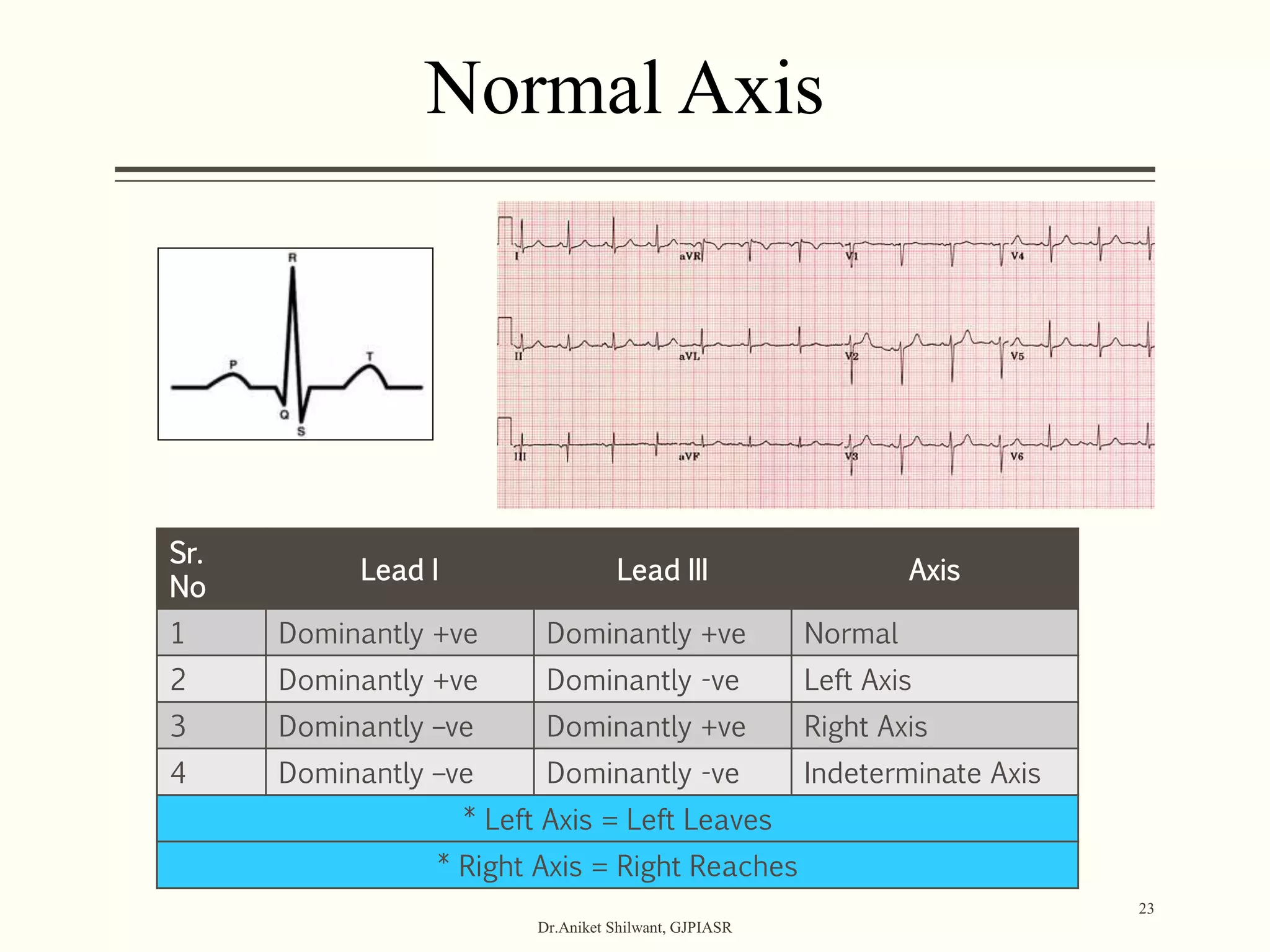 Normal Axis
Sr.
No
Lead I Lead III Axis
1 Dominantly +ve Dominantly +ve Normal
2 Dominantly +ve Dominantly -ve Left Axis
3 Dominantly –ve Dominantly +ve Right Axis
4 Dominantly –ve Dominantly -ve Indeterminate Axis
* Left Axis = Left Leaves
* Right Axis = Right Reaches
Dr.Aniket Shilwant, GJPIASR
23
 