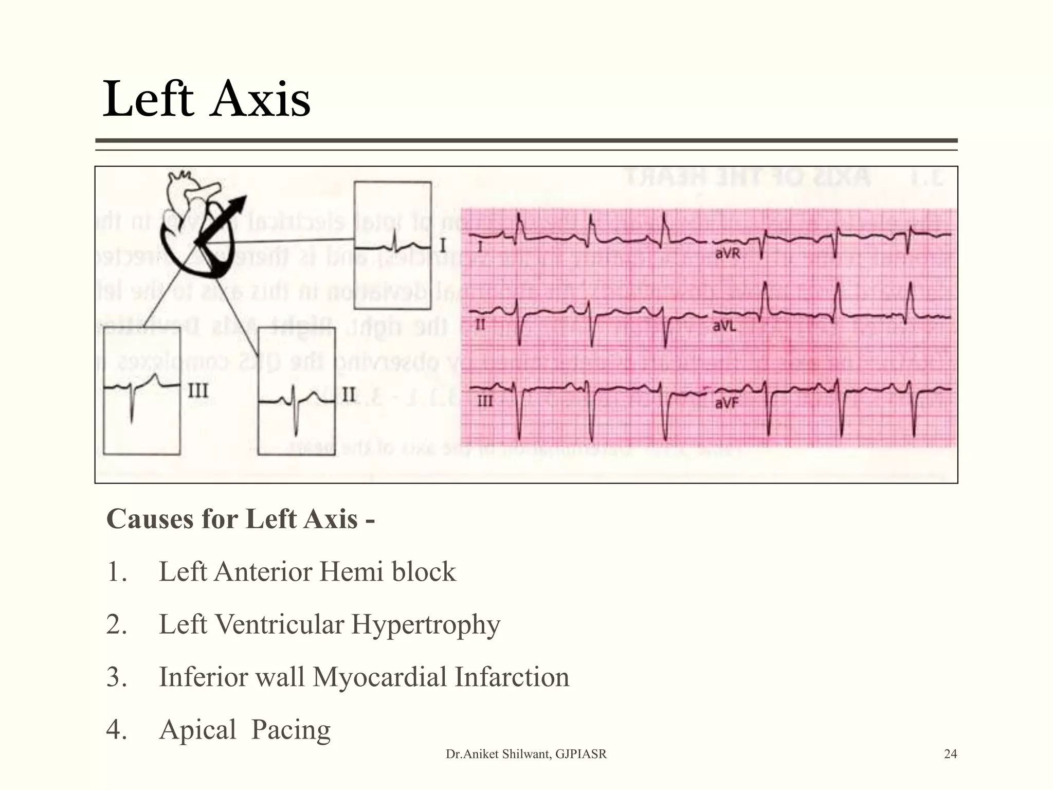 Left Axis
Dr.Aniket Shilwant, GJPIASR 24
Causes for Left Axis -
1. Left Anterior Hemi block
2. Left Ventricular Hypertrophy
3. Inferior wall Myocardial Infarction
4. Apical Pacing
 