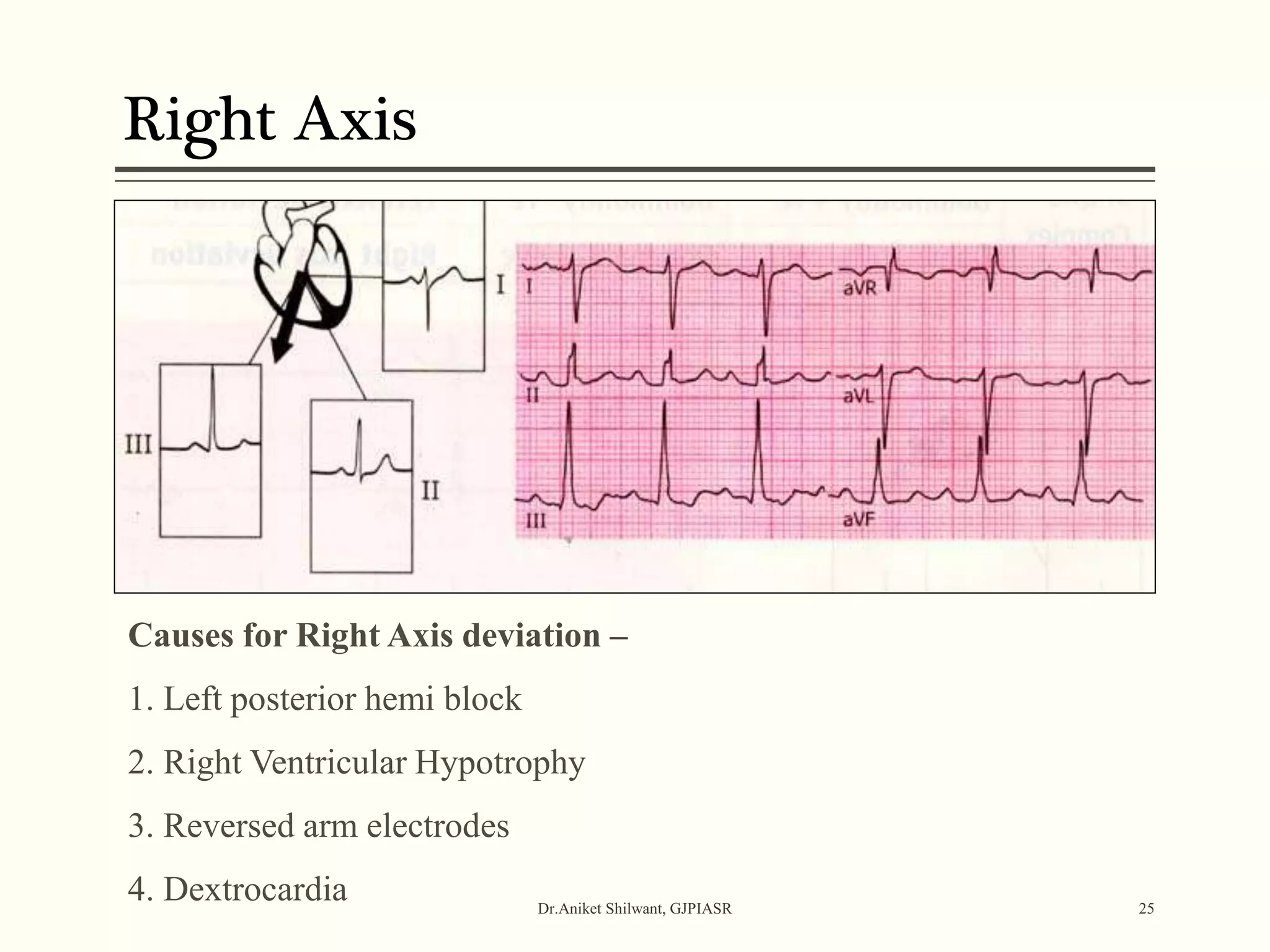 Right Axis
Dr.Aniket Shilwant, GJPIASR 25
Causes for Right Axis deviation –
1. Left posterior hemi block
2. Right Ventricular Hypotrophy
3. Reversed arm electrodes
4. Dextrocardia
 