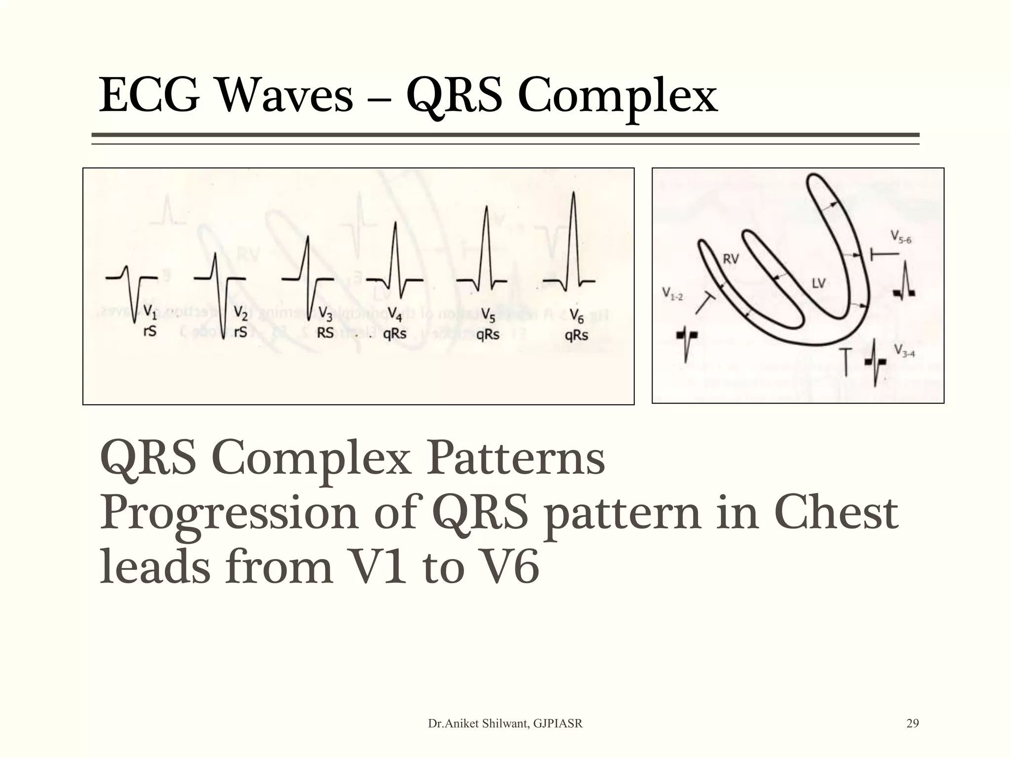 QRS Complex Patterns
Progression of QRS pattern in Chest
leads from V1 to V6
Dr.Aniket Shilwant, GJPIASR 29
ECG Waves – QRS Complex
 