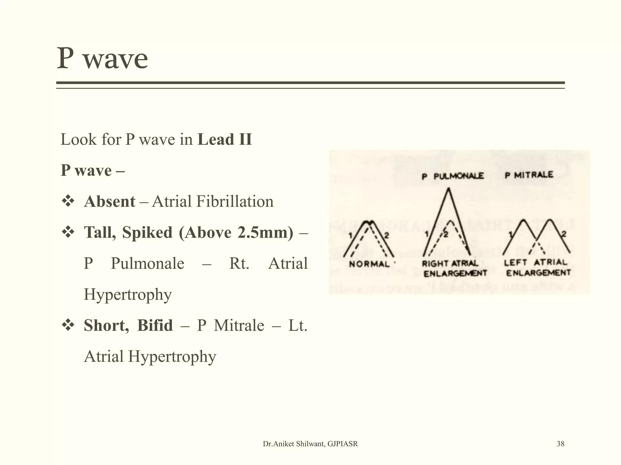P wave
Dr.Aniket Shilwant, GJPIASR 38
Look for P wave in Lead II
P wave –
 Absent – Atrial Fibrillation
 Tall, Spiked (Above 2.5mm) –
P Pulmonale – Rt. Atrial
Hypertrophy
 Short, Bifid – P Mitrale – Lt.
Atrial Hypertrophy
 