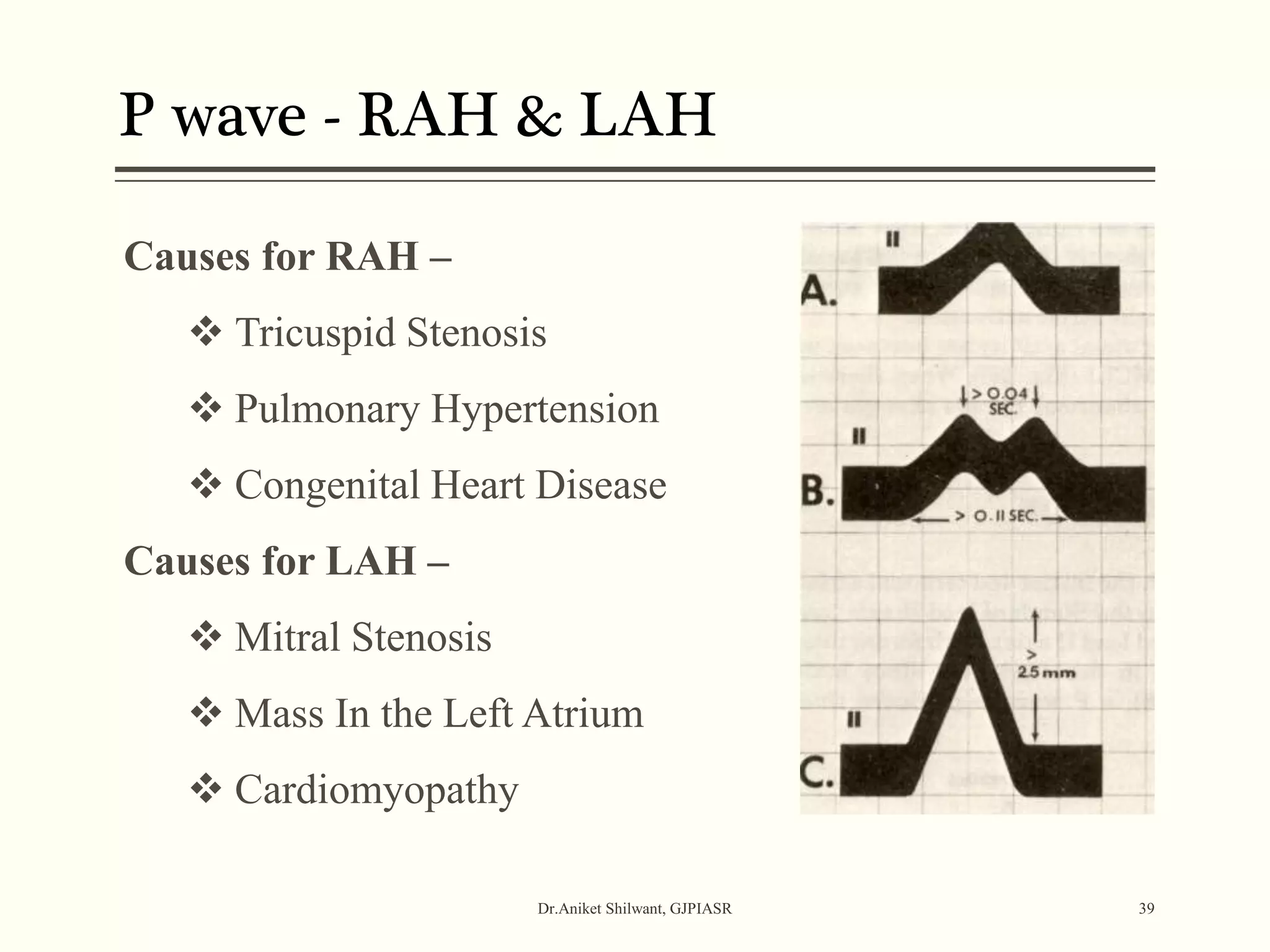 P wave - RAH & LAH
Dr.Aniket Shilwant, GJPIASR 39
Causes for RAH –
 Tricuspid Stenosis
 Pulmonary Hypertension
 Congenital Heart Disease
Causes for LAH –
 Mitral Stenosis
 Mass In the Left Atrium
 Cardiomyopathy
 