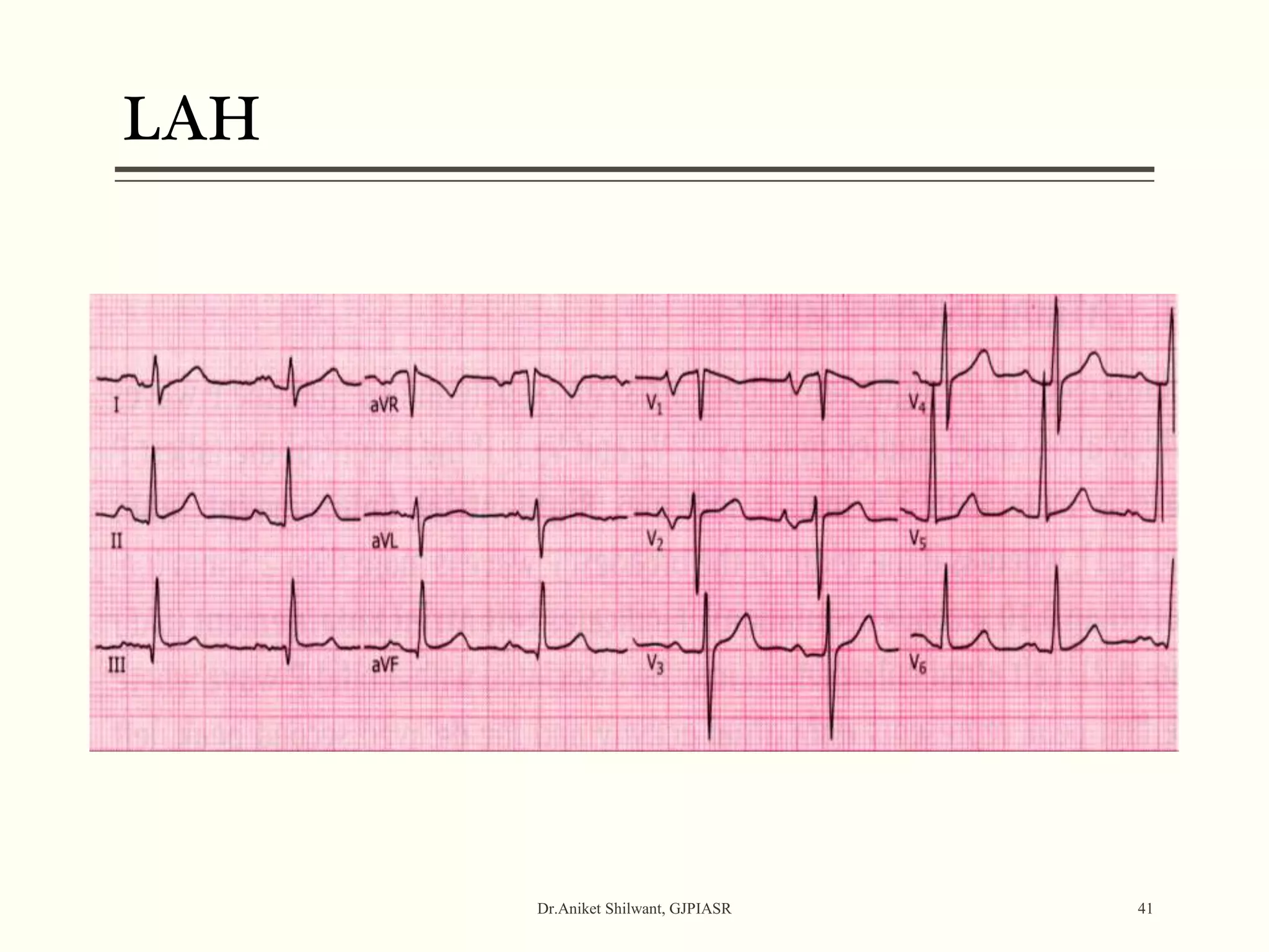 LAH
Dr.Aniket Shilwant, GJPIASR 41
 