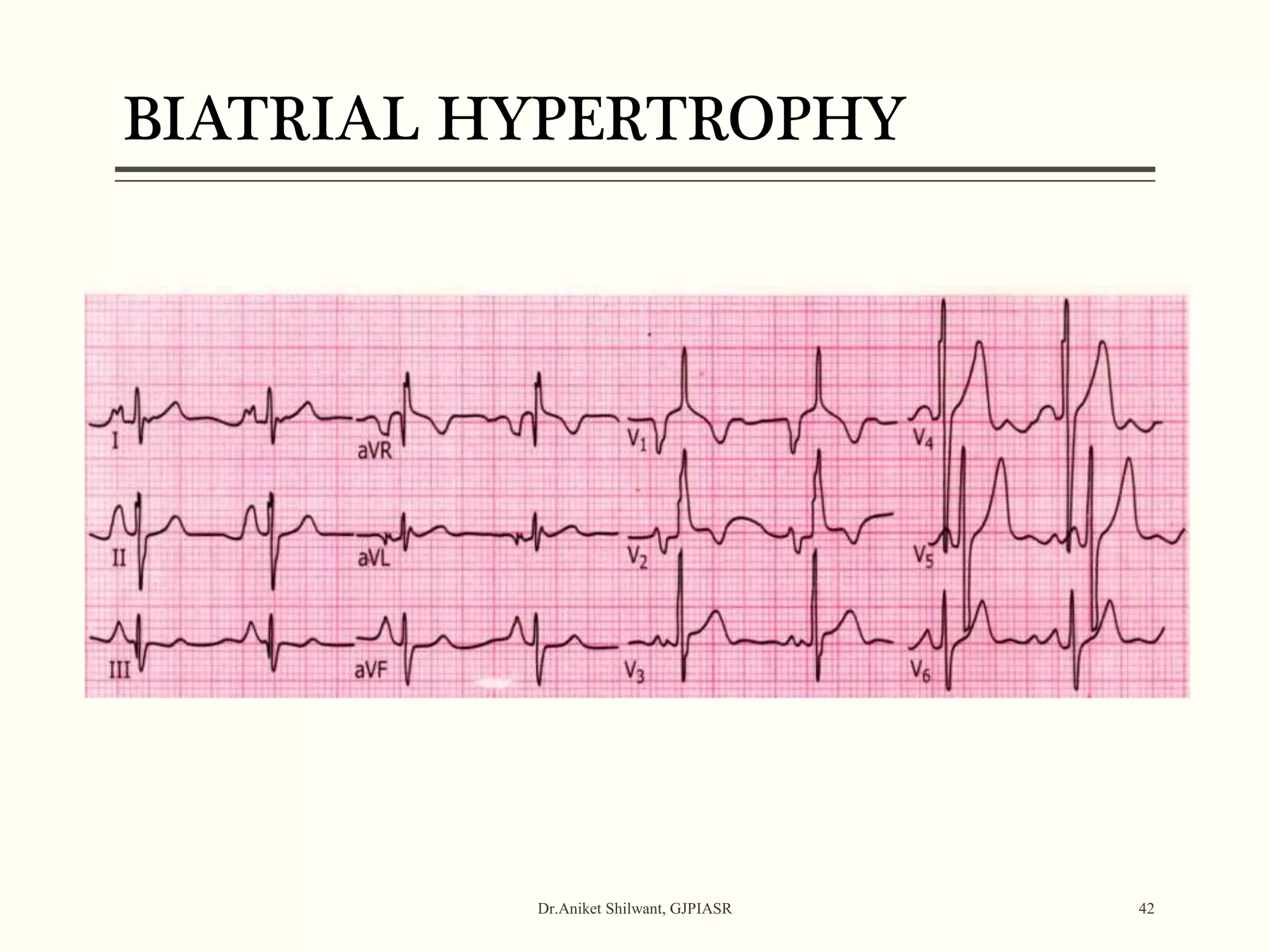 BIATRIAL HYPERTROPHY
Dr.Aniket Shilwant, GJPIASR 42
 