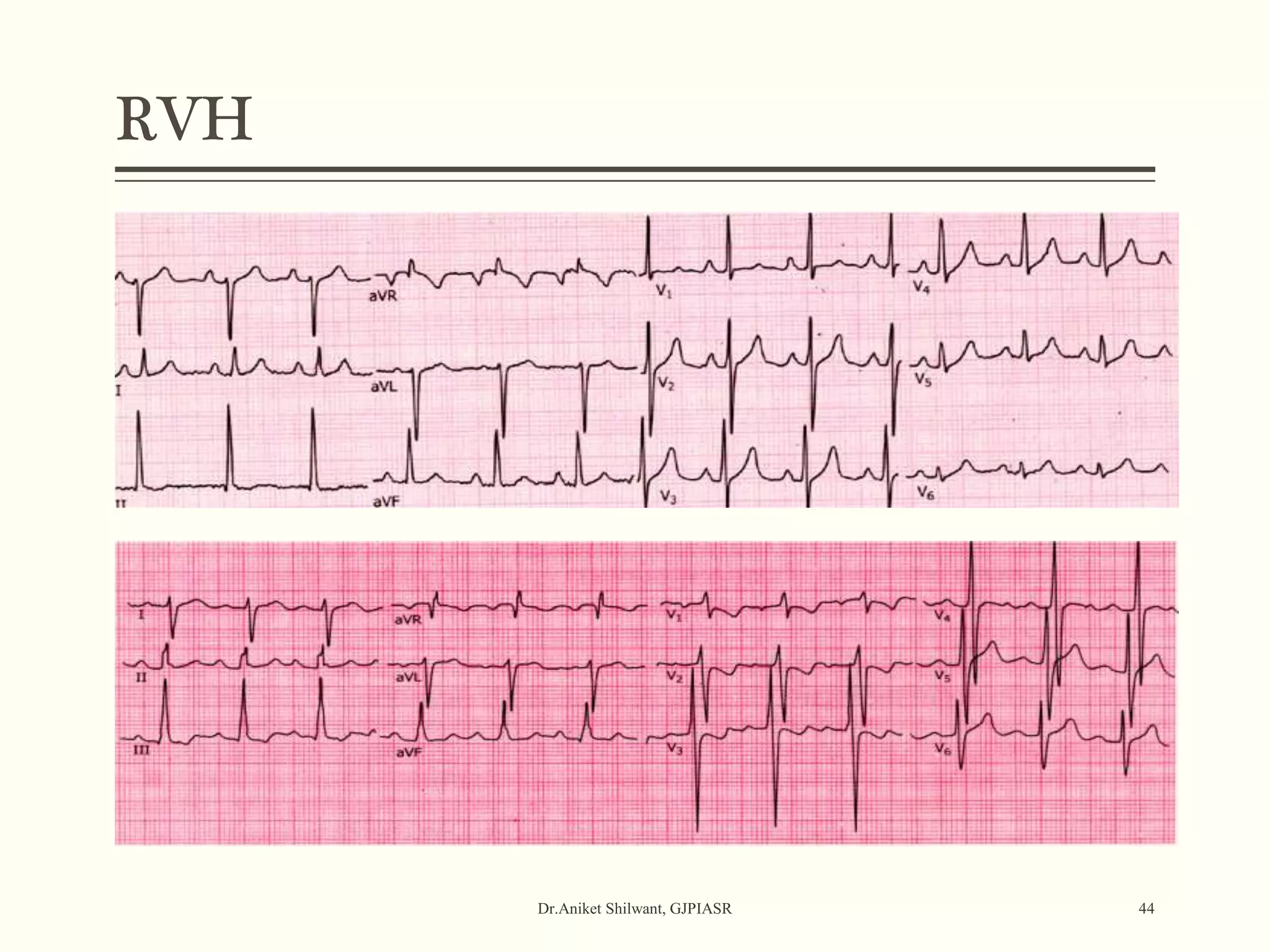 RVH
Dr.Aniket Shilwant, GJPIASR 44
 
