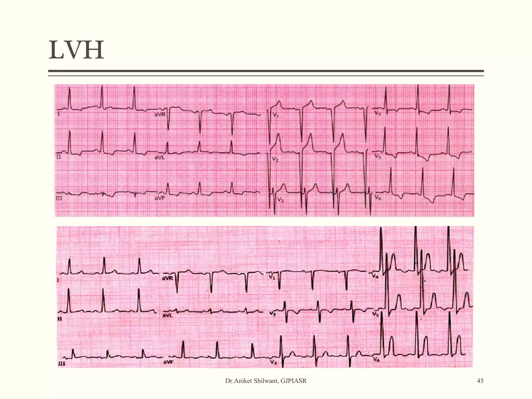 LVH
Dr.Aniket Shilwant, GJPIASR 45
 