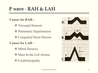 ECG BASICS | PPT