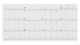 ECG BASICS PRESENTATION .pptx