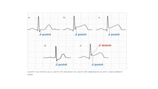 ECG BASICS PRESENTATION .pptx