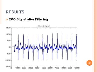 RESULTS
 ECG Signal after Filtering
32
 