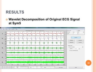 RESULTS
 Wavelet Decomposition of Original ECG Signal
at Sym5
33
 