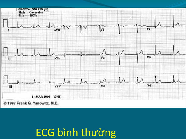 ECG bệnh mạch vành mạn.pptx