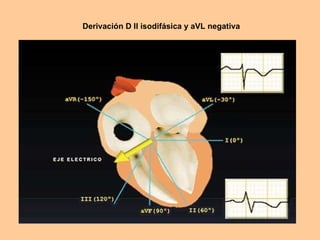 Derivación D II isodifásica y aVL negativa 