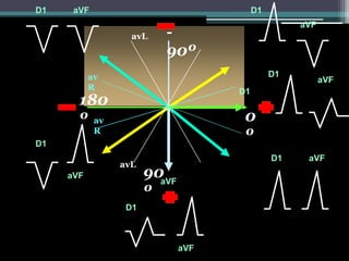 D1    aVF                                D1
                                                   aVF
                  avL    -
                         90º
           av                                 D1
                                                         aVF
           R                        D1
       180
       º av                          0
D1
            R
                                     º
                                              D1    aVF
                avL
     aVF              90aVF
                      º
                 D1



                              aVF
 