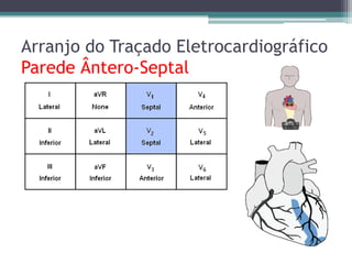 Arranjo do Traçado Eletrocardiográfico
Parede Ântero-Septal
 