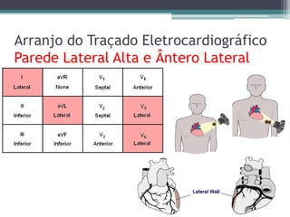 Arranjo do Traçado Eletrocardiográfico
Parede Lateral Alta e Ântero Lateral
 