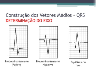 Construção dos Vetores Médios – QRS
DETERMINAÇÃO DO EIXO




Predominantemente   Predominantemente   Equifásica ou
     Positiva            Negativa            Iso
 