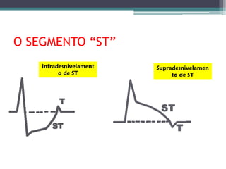 O SEGMENTO “ST”
    Infradesnivelament   Supradesnivelamen
          o de ST             to de ST
 