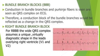 V1 Conduction Block ECG by Adil.pptx