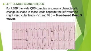  LEFT BUNDLE BRANCH BLOCK
For LBBB the wide QRS complex assumes a characteristic
change in shape in those leads opposite the left ventricle
(right ventricular leads - V1 and V2 ) – Broadened Deep S
waves
 