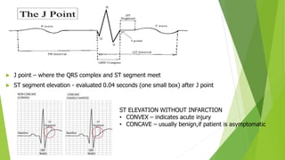  J point – where the QRS complex and ST segment meet
 ST segment elevation - evaluated 0.04 seconds (one small box) after J point
ST ELEVATION WITHOUT INFARCTION
• CONVEX – indicates acute injury
• CONCAVE – usually benign,if patient is asymptomatic
 