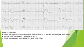 Points to consider :
• There are hyperacute T-waves in V2-6 (most marked in V2 and V3) with loss of R wave height.
• Normal sinus rhythm with 1st degree AV block
• These features indicate HYPERACUTE ANTERIOR STEMI
 