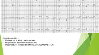 Points to consider :
• ST elevation in V2-6, Lead I and aVL.
• Reciprocal ST depression in III and AVF.
• These features indicate EXTENSIVE ANTEROLATERAL STEMI
 