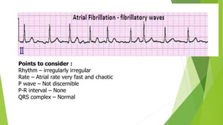 Points to consider :
Rhythm – irregularly irregular
Rate – Atrial rate very fast and chaotic
P wave – Not discernible
P-R interval – None
QRS complex – Normal
 