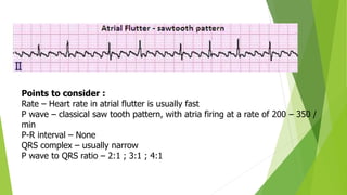 Points to consider :
Rate – Heart rate in atrial flutter is usually fast
P wave – classical saw tooth pattern, with atria firing at a rate of 200 – 350 /
min
P-R interval – None
QRS complex – usually narrow
P wave to QRS ratio – 2:1 ; 3:1 ; 4:1
 