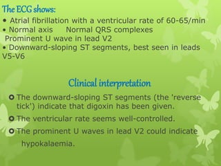 The ECG shows:
• Atrial fibrillation with a ventricular rate of 60-65/min
• Normal axis Normal QRS complexes
Prominent U wave in lead V2
• Downward-sloping ST segments, best seen in leads
V5-V6
Clinical interpretation
 The downward-sloping ST segments (the 'reverse
tick') indicate that digoxin has been given.
 The ventricular rate seems well-controlled.
 The prominent U waves in lead V2 could indicate
hypokalaemia.
 